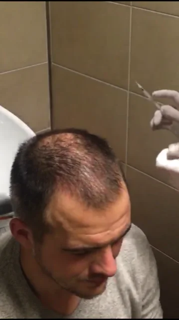Nico vóór zijn eigen haartransplantatie