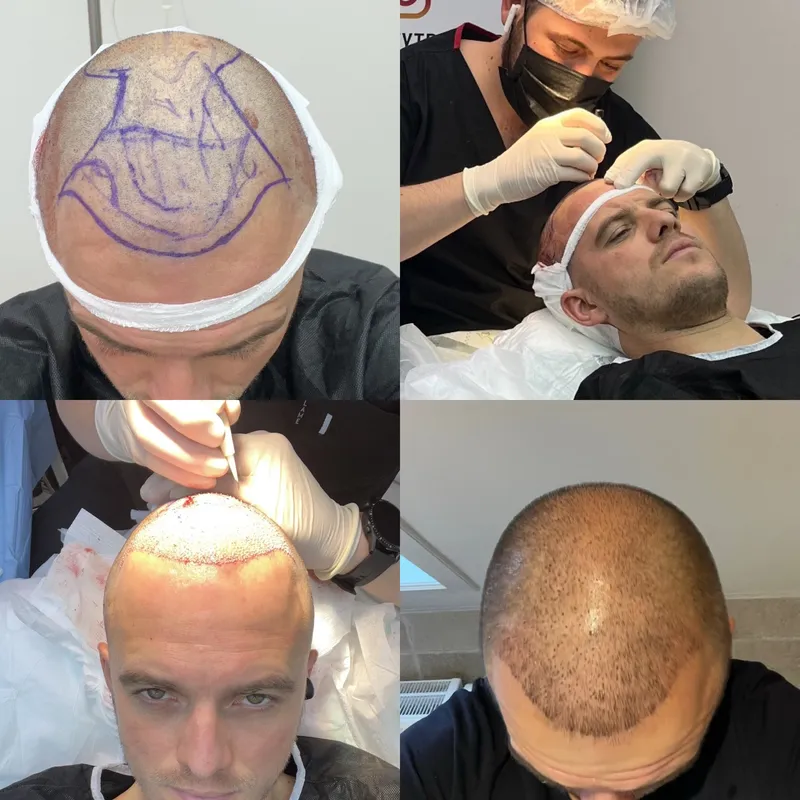 Vier beelden van een FUE-haartransplantatie: de haarlijn tekenen, haarwortels oogsten, implanteren en het resultaat